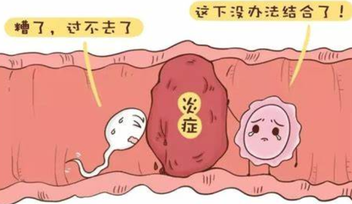 输卵管堵塞