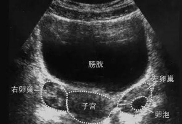 B超监测卵泡大小